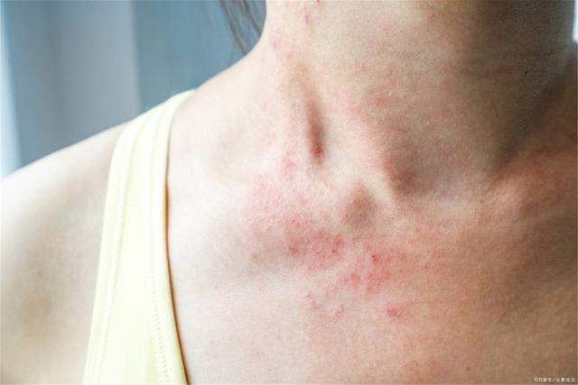 汗疱疹是什么原因引起，汗疱疹如何治才能根除